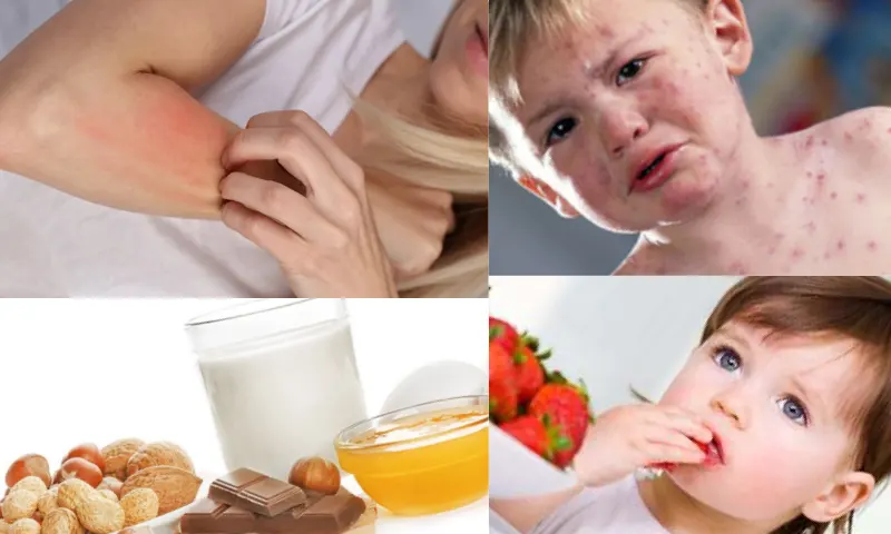Gıda Alerjisinin Tanımı ve Temel Nedenleri