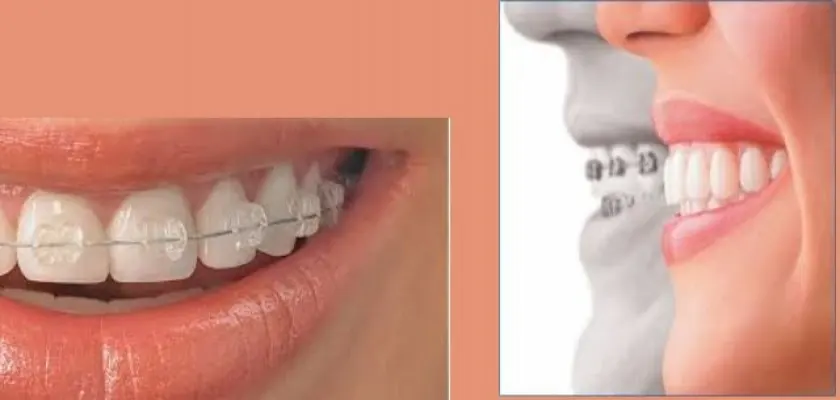 Ortodonti Nedir, Kimlere Uygulanır?