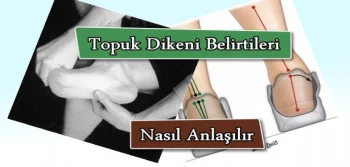 Topuk Dikeni Belirtileri Nasıl Anlaşılır?