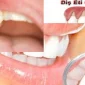 Diş Eti Hastalıkları Nedir Nasıl Tedavi Edilir?